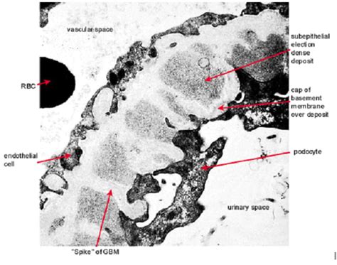 spike and dome appearance membranous nephropathy|Membranous Nephropathy: Core Curriculum 2021 .